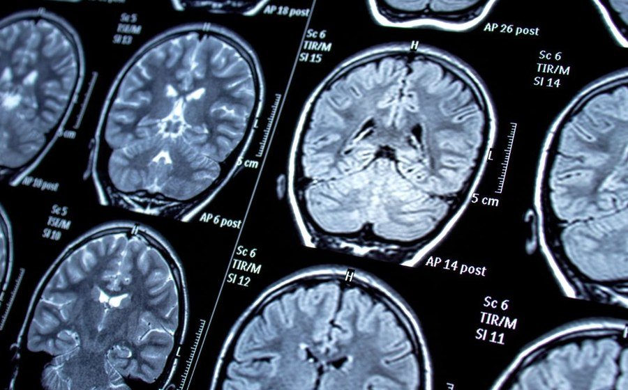 Neurosurgery at Sarabsukh Hospital Batala